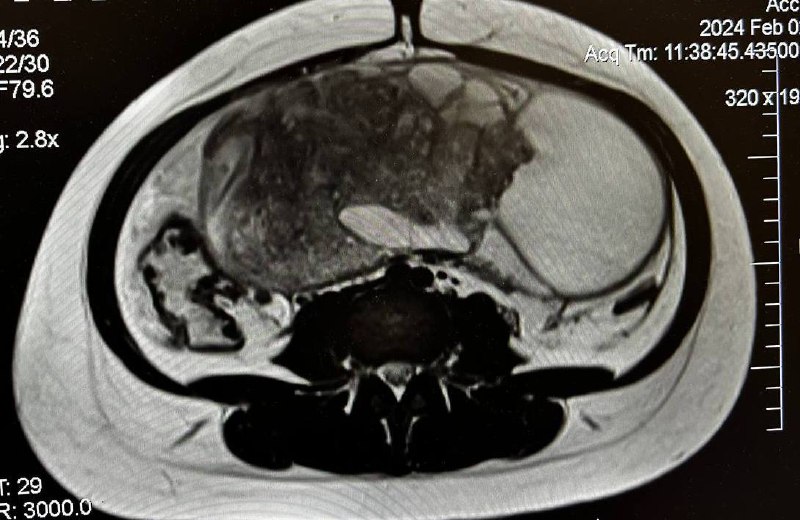 Пятикилограммовую опухоль удалили у девушки врачи двух кузбасских больниц