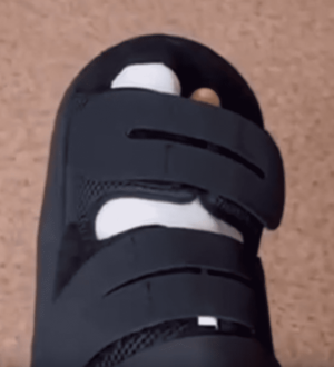 Впервые в Кузбассе пациентку избавили от «косточки на стопе» без открытой операции