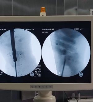 В Кузбассе врачи вживили в ногу раненому на СВО солдату биомеханический имплант