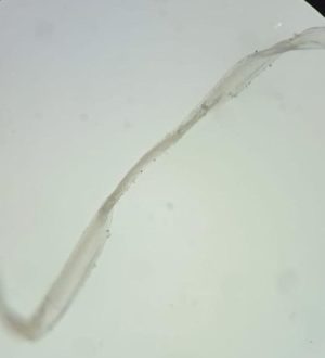 Врачи в Кемерове вытащили 4-сантиметрового червя из глаза женщины