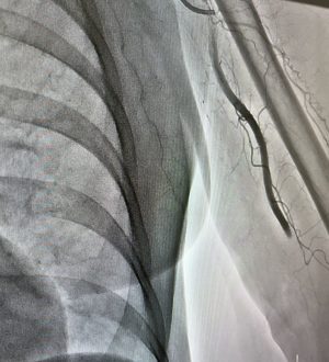 Новокузнецкие хирурги извлекли из артерии пациента 7-сантиметровый тромб