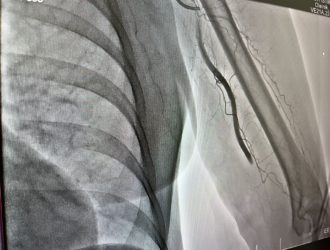 Новокузнецкие хирурги извлекли из артерии пациента 7-сантиметровый тромб