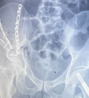 В Кузбассе врачи по кусочкам собрали сломанный таз упавшего с 4 этажа пациента