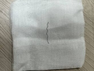 В Кузбассе медики извлекли из шеи женщины кусок проволоки