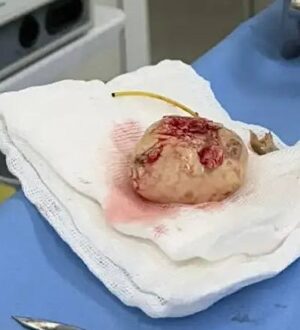 В Кузбассе пациенту пришлось удалить почку вместе с огромным камнем