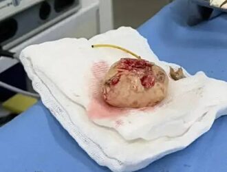 В Кузбассе пациенту пришлось удалить почку вместе с огромным камнем