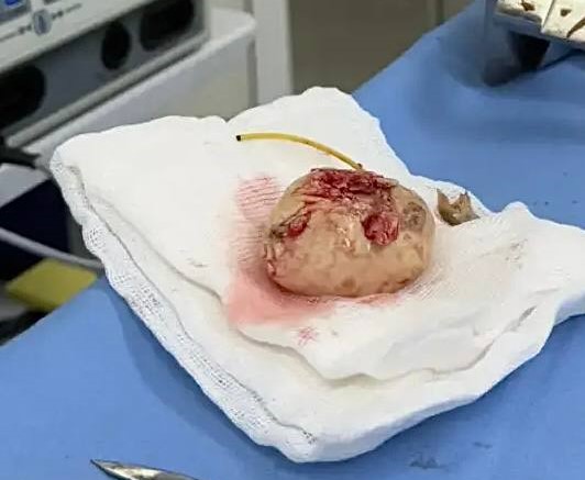 В Кузбассе пациенту пришлось удалить почку вместе с огромным камнем