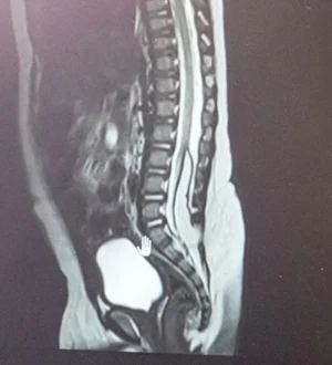 Двоих малышей с редкой аномалией ЦНС спасли кузбасские врачи