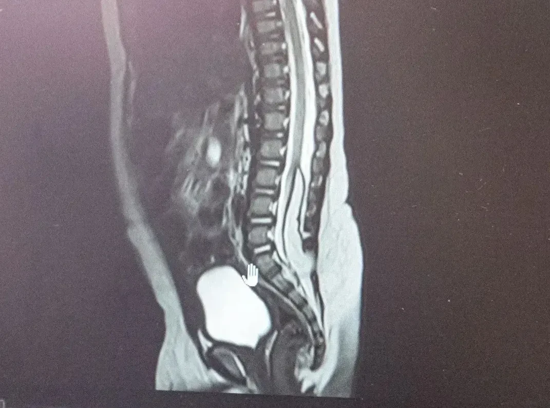 Двоих малышей с редкой аномалией ЦНС спасли кузбасские врачи